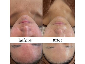 ベレミアム(Bellemium)/敏感肌.ごわつき.肌トラブル改善