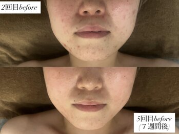 サロンワイアネシス(Salon y ANESIS)/ハーブピーリング 5回