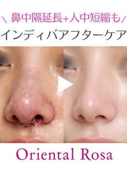オリエンタルローザ 表参道(Oriental Rosa)/鼻中隔延長+人中短縮術後最短で!