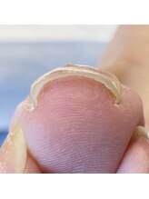 地爪ケアクリニックサロン 代々木店/巻き爪ケア【STEP4】