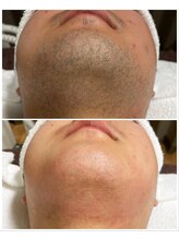 ヴァイオス 八王子(VIOS)/【圧倒的清潔感】髭脱毛