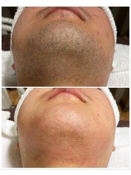 ヴァイオス 八王子(VIOS)/【圧倒的清潔感】髭脱毛