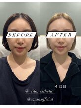 シロ(silo.)/美顔器とヘッドスパ