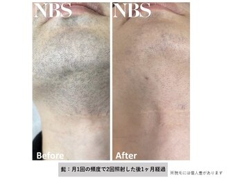 ヴァンカウンシル 豊橋店(VANCOUNCIL)/メンズ脱毛