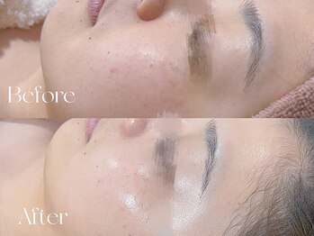 ウィハナ(wehana)/【ララピール】くすみ/シワ/しみ