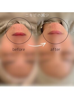 &still【アンドスティル】【4/1 NEW OPEN(予定)】 /【水光ピーリング】