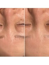 ファビリス 天王寺店(FAVILIS)/ACトリートメント1回/50代