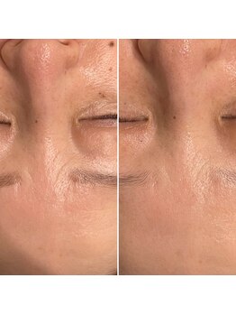 ファビリス 天王寺店(FAVILIS)/ACトリートメント1回/50代