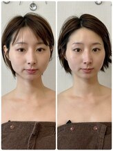 メディカルエース(MedicalAce)/【最強引き上げ】ハイサーマ