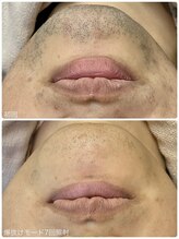 ヒスイ バイ アメイジング(Hisui by AMAZING)/【光脱毛】男性髭 &nbsp;IPL &nbsp;&nbsp;爆抜け