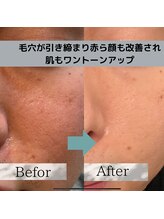 レベンディス(LEVENDIS)/光フェイシャルBBL