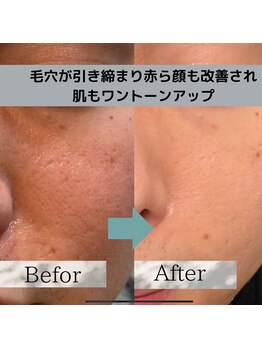 レベンディス(LEVENDIS)/光フェイシャルBBL