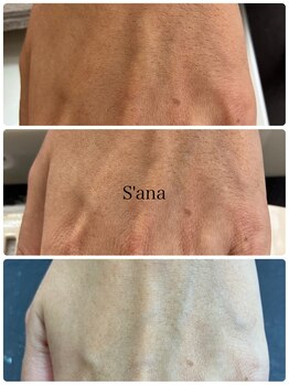 サナ 久が原 千鳥町(S’ana)/ルビッシュ照射