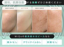 温凪 心斎橋(MINAGI)/ワイコ水光ピーリング