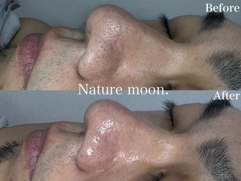 ナチュールムーン(Nature moon.)/毛穴洗浄