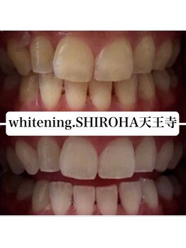 シロハ(SHIROHA)/セルフホワイトニング/天王寺