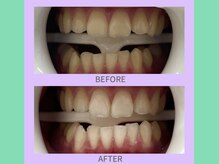 ココティ ホワイトニング(Cocotii)/ビフォーアフター