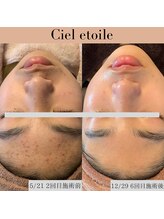 シエルエトワレ/メンズ 毛穴エクストラクション