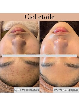 シエルエトワレ/メンズ 毛穴エクストラクション