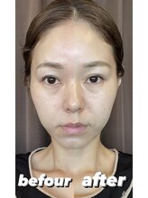 みき接骨院/美容鍼とニードルレスで変化　２