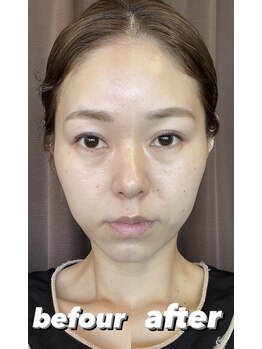 みき接骨院/美容鍼とニードルレスで変化　２