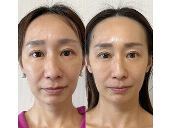 メディカルエース(MedicalAce)/【最強引き上げ】ハイサーマ