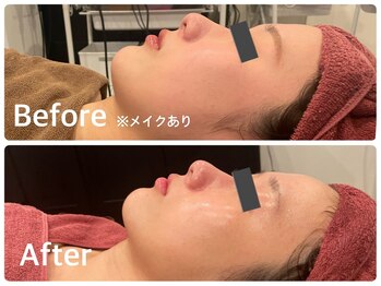 マリスレジーナ 新保店(MarisRegina)/ララピール 1回 BeforeAfter