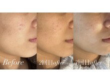 ベルバーチュプラス(Belle Virtue +)/カーボキシー&ハーブピーリング