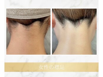 アンド エヌ(&n)/◆襟足脱毛◆