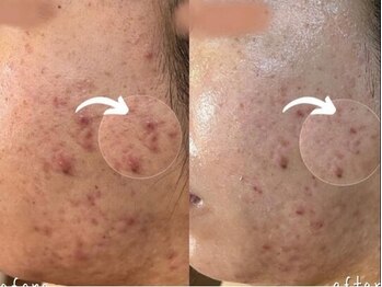 オリーブ コクブンジ(Olive kokubunji)/ハーブピーリング｜ニキビケア