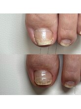 リリ(lili)/巻き爪矯正2回目（左親指）