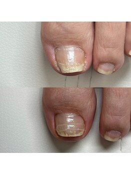 リリ(lili)/巻き爪矯正2回目(左親指)