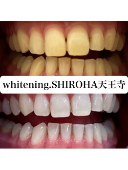シロハ(SHIROHA)/セルフホワイトニング/天王寺