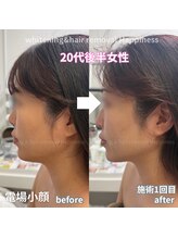 ハピネス 心斎橋アメリカ村本店(Happiness)/20代後半女性