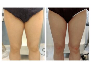 ルアナ(Luana)/太もも脂肪冷却でスッキリ脚に♪
