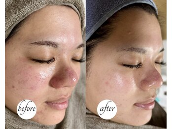 ルーム(lume)/before/after 1ヶ月後
