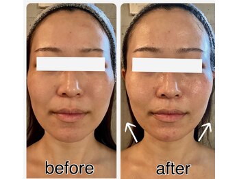 ニコリ(nicori)/小顔矯正＆ピールbeforeとafter