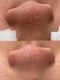 ラルガ 城野店(Raruga)の写真/毛穴洗浄＋ワックス鼻→鎮静パックが破格の3000円でのご提供!!黒ずみ・詰まり毛穴・いちご鼻にサヨナラ！