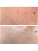 ダチュラ(Da'Chura)/フェイシャルワックス脱毛