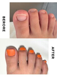 【美爪育成】《フット》深爪改善