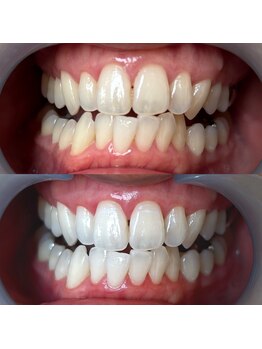 ワールドビューティー(World Beauty)/30代男性/ホワイトニング　３回