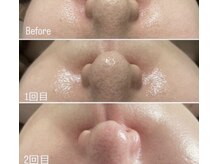 グロウ(GLOW)/ラミネーションピール★