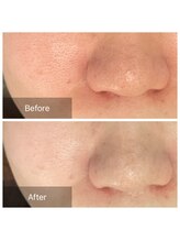 ビビ(VIVI)/毛穴ケアにララピール