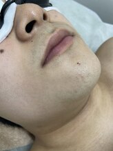 ナノハナ/鹿沼市の全身脱毛のナノハナ