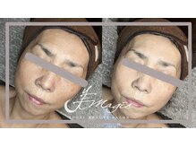 ビーマジック(美magic)/アクアダーマ+ララピール症例