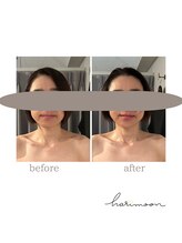 ハリムーン 仙台(harimoon)/美容鍼灸ビフォーアフター