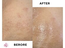 フロー(Flow)/ハーブピーリング