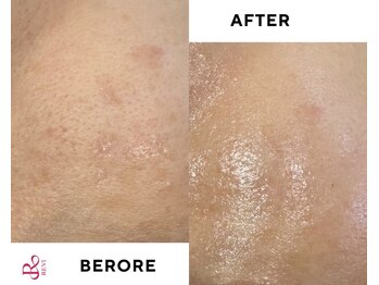 フロー(Flow)/ハーブピーリング