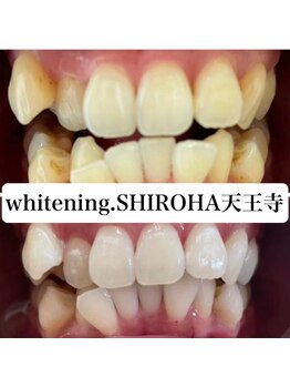 シロハ(SHIROHA)/セルフホワイトニング/天王寺
