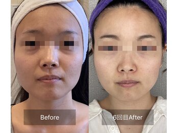 ラ クレール ビューティーサロン(LA CLAIR)/小顔リフトマシン豊富に取り揃え